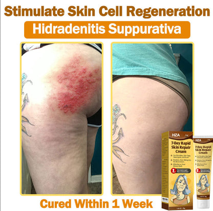 HZA𝟕-𝐃𝐚𝐲 𝐑𝐚𝐩𝐢𝐝 𝐒𝐤𝐢𝐧 𝐑𝐞𝐩𝐚𝐢𝐫 𝐂𝐫𝐞𝐚𝐦 𝐔𝐊 𝐃𝐞𝐫𝐦𝐚𝐭𝐨𝐥𝐨𝐠𝐢𝐬𝐭 𝐀𝐩𝐩𝐫𝐨𝐯𝐞𝐝 (💎💎𝐁𝐀𝐃 𝐑𝐄𝐂𝐎𝐌𝐌𝐄𝐍𝐃𝐄𝐃)