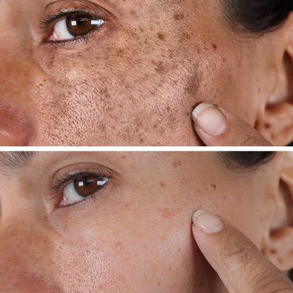 (🔥Promozione ultimo giorno 70% DI SCONTO) Fast Dark Spot Remover-AQA™ Melanin Correcting Facial Serum